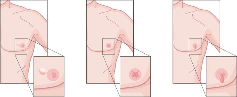 Câncer de mama em homens 